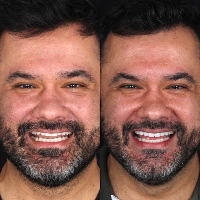 Facetas - Clínica DYVARE Urussanga